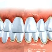 A periodontitis élvezet otthon népi jogorvoslati
