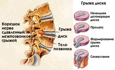 Kezelés előnyeit a gerinc sérv magánklinikák