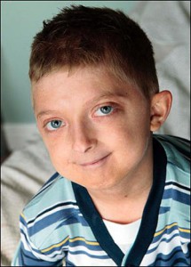 Progeria (Hutchinson-Gilford szindróma) - a betegség, amely hozza az élet a „gyors előre” portálon
