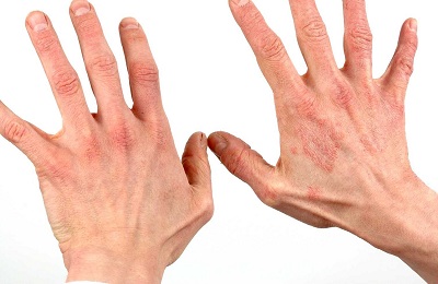 Száraz ekcéma a kézen, mint tüneteinek kezelésére és okai