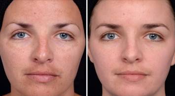 Ultrahangos tisztító az arc -, hogy ez, javallatok és ellenjavallatok