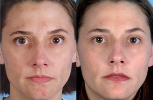 Ultrahangos tisztító az arc előtt és után, az előnyök és hátrányok az ultrahang, a beteg véleménye
