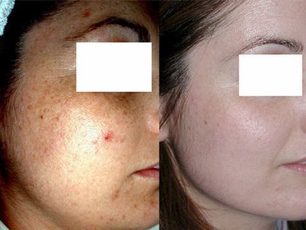 Ultrahangos tisztító az arc előtt és után, az előnyök és hátrányok az ultrahang, a beteg véleménye