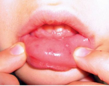 Vírusos pemphigus gyermekeknél, hogy ez egy (virális) Vírusos bőrhólyagosodás gyermekek, mi ez