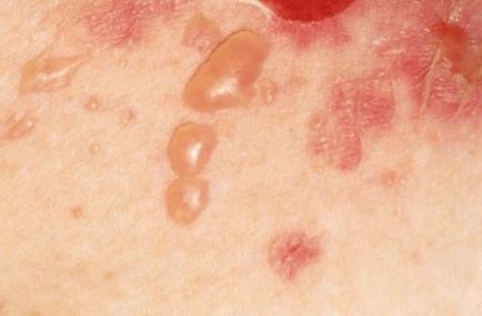 Vírusos pemphigus gyermekeknél, hogy ez egy (virális) Vírusos bőrhólyagosodás gyermekek, mi ez