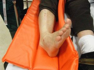 Kificamodott láb mellett a boka okai, kezelése
