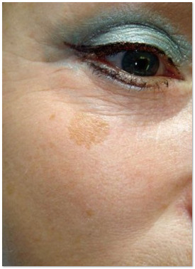 Életkor pigment, mert, hogyan lehet megszabadulni (kor pigment) Életkor pigment, mert, hogyan lehet megszabadulni