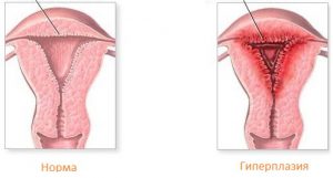 Mirigyes endometrium hiperplázia, mi ez