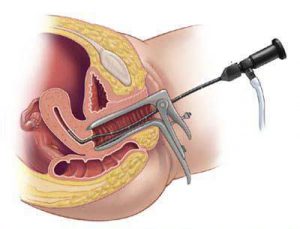 Mirigyes endometrium hiperplázia, mi ez