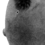 Glandular mell - rostos és cisztás (mirigyes) Glandular mell - rostos és cisztás