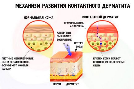Dermatitis, mit kell tenni
