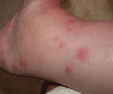 Allergiás a harapás szúnyogok