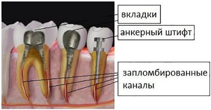 Mi egy horgony pin Mi egy horgony csap