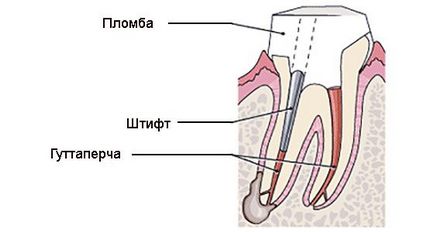 Mi egy horgony pin Mi egy horgony pin