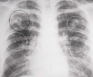 Mi tüdő tuberkulóma Mi tüdő tuberkulóma