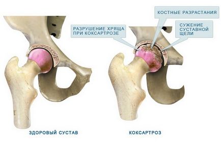 Kezelése arthrosis deformans népi jogorvoslat