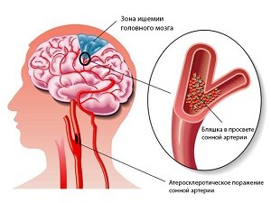 agy encephalopathia kezelésére