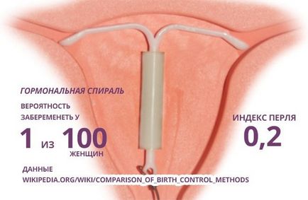 Hormonális fogamzásgátló coil - megbízható fogamzásgátló