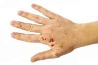 Kezelésére használt készítmények dermatitis