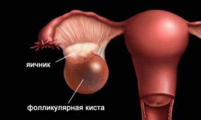 Follicle robban miért nem Follicle robban miért nem