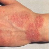 Kezelésére használt készítmények dermatitis