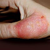 Kezelésére használt készítmények dermatitis Kezelésére használt készítmények dermatitis