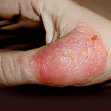 Kezelésére használt készítmények dermatitis