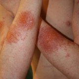 Kezelésére használt készítmények dermatitis