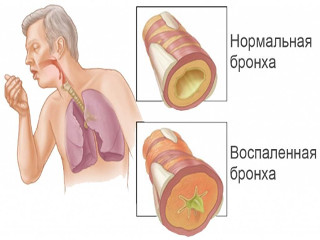 Hogyan működik bronchitis