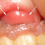 A öblítse ki a száját a ínygyulladás és ínyvérzés