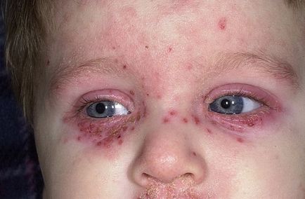 Purpura - fotók a gyermekek, a lábak, arc, fenék, okok, vasculitis