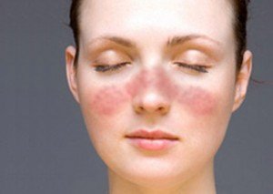 Hogyan lehet eltávolítani a bőrpír az arc gyorsan és tartósan, annak okai