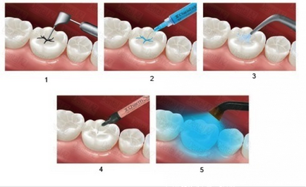 A legjobb módja, hogy megakadályozzák a fogszuvasodás - fogat Barázdazárás