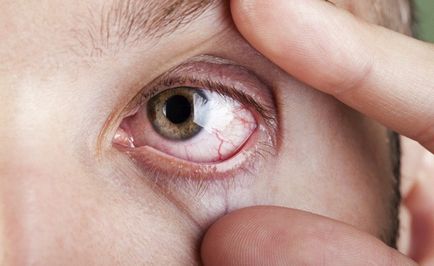 Miért pír szem okait vörös szem fehérjék