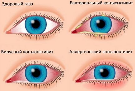 Miért pír szem okait vörös szem fehérjék