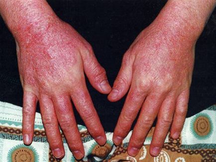 Allergia e kéz, mely