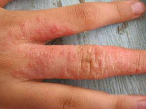 Allergia e kéz, mely