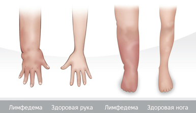 Mi lymphostasis lábak