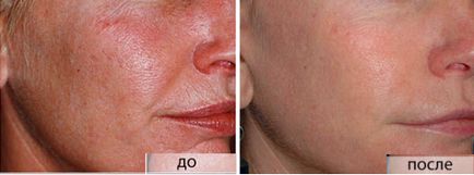 Peeling otthon gyümölcssavak Peeling otthon gyümölcssavak