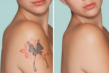 Hogyan és mit kell eltávolítani a tetoválást