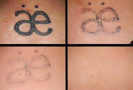 Hogyan és mit kell eltávolítani a tetoválást