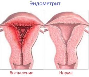 krónikus endometritis kezelése népi jogorvoslat