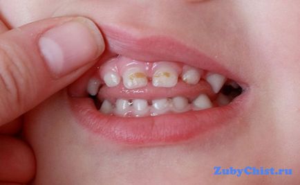 Hogyan lehet gyógyítani a fogat gyermek