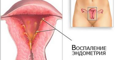 krónikus endometritis kezelése népi jogorvoslat