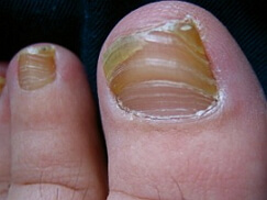 onychomycosis köröm kezelés