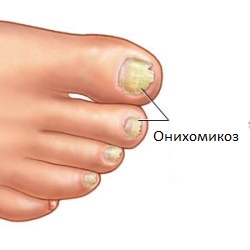 onychomycosis köröm kezelés