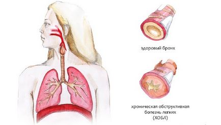 A krónikus obstruktív bronchitis kezelésére