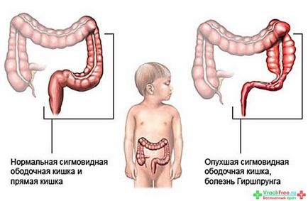 Mi a teendő, ha a székrekedés Mi a teendő, ha a székrekedés