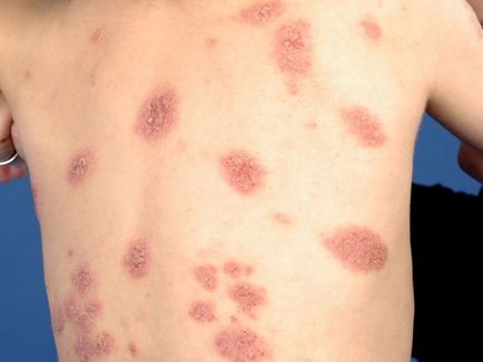 Allergiás bőrkiütés gyermekeknél néz ki, mint a képen, különféle allergiák a bőrön, a tünetek és a kezelés (a gyermek nem felel allergiás bőrkiütés) Allergiás bőrkiütés gyermekeknél néz ki, mint a képen, különféle allergiák a bőrön, tünetei és kezelése