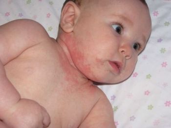 Allergiás bőrkiütés gyermekeknél néz ki, mint a képen, különféle allergiák a bőrön, tünetei és kezelése